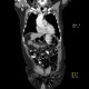 Inguinal hernia: CT - Computed tomography